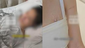 강도 흉기에 20여 차례 찔린 여성…'미용 성형' 덕분에 목숨 건졌다