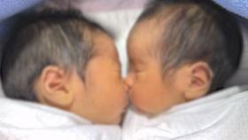 [와글와글] 10만분의 1 확률 '겹쌍둥이' 탄생