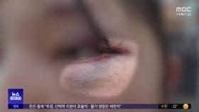시퍼렇게 멍든 '노동자'‥