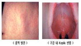 국내 홍역환자, 작년의 1.4배…