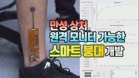 [세상만사] 만성 상처 원격 모니터링 가능한 스마트 붕대 개발