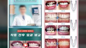 해외 직구 투명치아교정기...과대 광고 무더기 적발