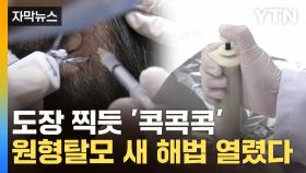 [자막뉴스] 모발 양까지 엄청난 효과...원형탈모 치료 '새 혁명'