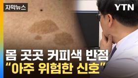 [자막뉴스] 방치했다간 생명까지 위협...'커피색 반점' 희귀병 징후
