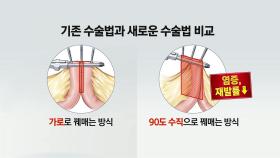 희귀질환 크론병, 장 꿰매는 방향 바꿨더니...합병증 '뚝'