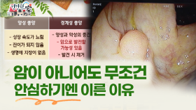 [건강한 家] 용종, 암 아니니까 괜찮아? 안심하기엔 이른 이유