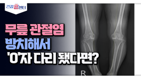 [건강 콜센터] 무릎 관절염 방치해서 ′O′자 다리 됐다면?