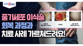 [건강 콜센터] 줄기세포 이식술회복 과정과 치료 사례 가르쳐드려요!