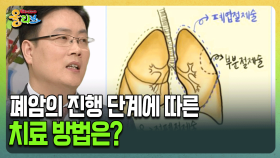 [건강버라이어티 올리브] 폐암의 진행 단계에 따른 치료 방법은?