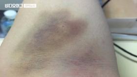 의사 남자친구에게 정신 잃을 때까지 폭행…＂살해 협박도＂
