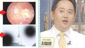 중년을 위협하는 눈 질환 ‘녹내장·백내장·황반병선’ (건강 대해부)