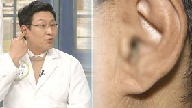 뇌의 노화 알리고 치매 신호 보내는 ‘귓불 주름’ (건강 대해부)