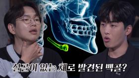 타살 가능성? 설골이 없는 채로 발견된 백골