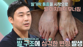 발가락 휘고 통증 있다면 의심해 봐야 하는 ‘무지외반증’ (더건강한스쿨)