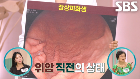 위암으로의 지름길인 ‘만성 위염’ (똑똑똑!고민상담소)