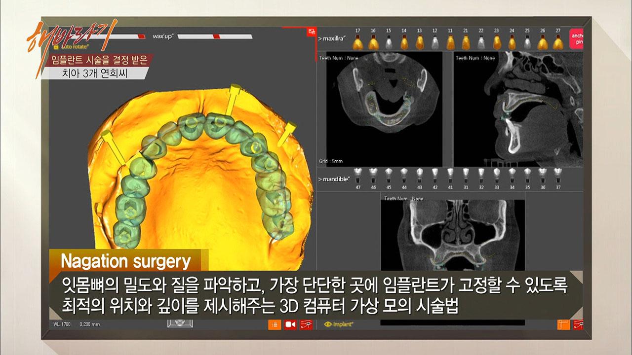연희씨에게 온 기회! 최고의 임플란트 시술! | ZUM TV