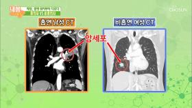 폐암, CT 사진만으로 흡연 여부를 알 수 있다?