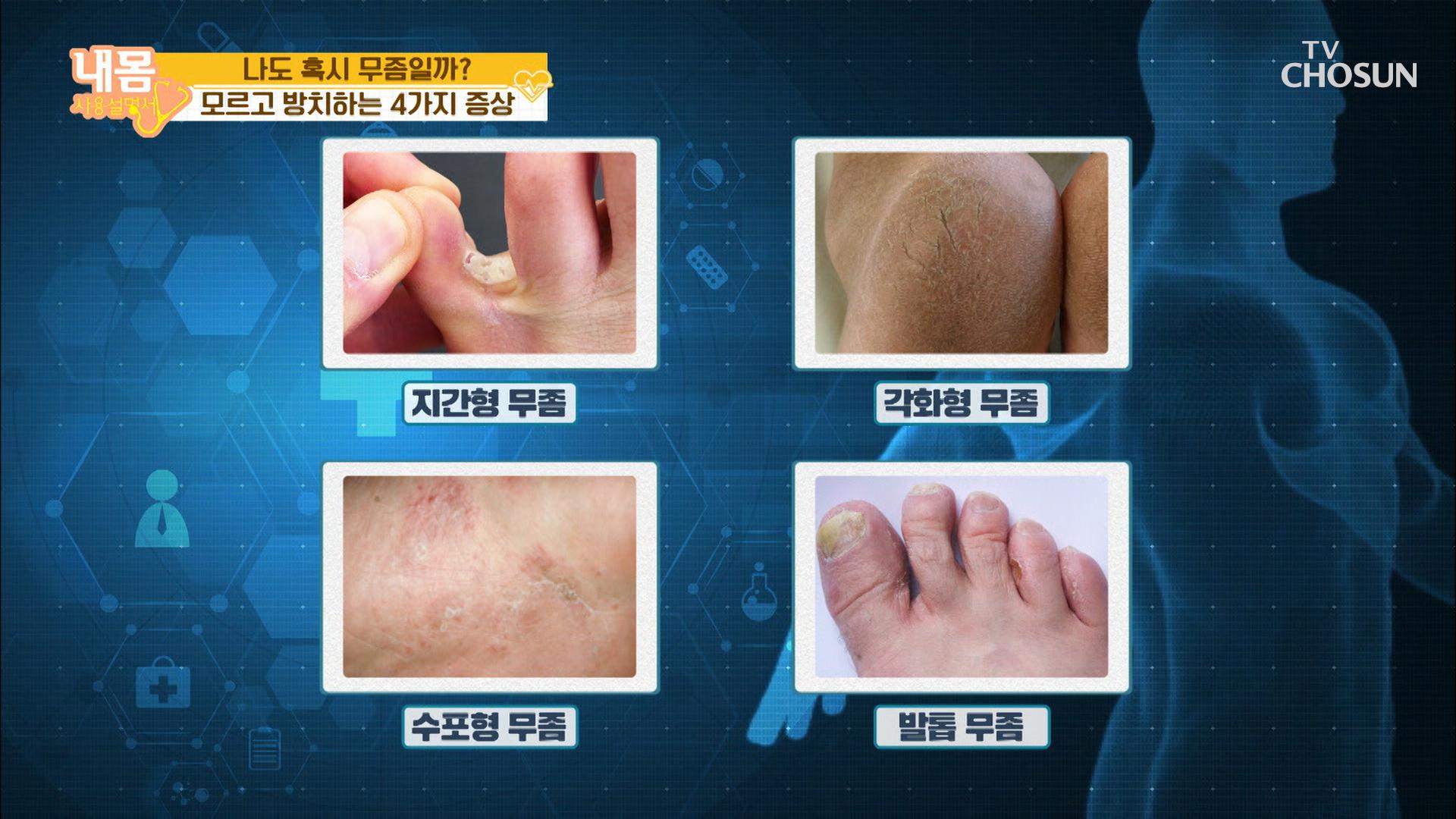 나도 혹시 무좀?! 증상에 따른 〈4가지 무좀 종류〉 | ZUM TV