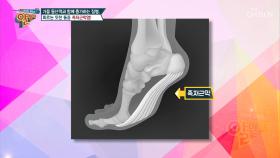 찌르는 듯한 통증 『족저근막염』 #광고포함| TV CHOSUN 20200920 방송